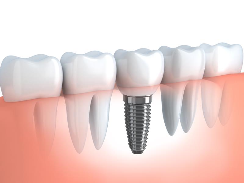 Dental Implants  Clinton, NY 