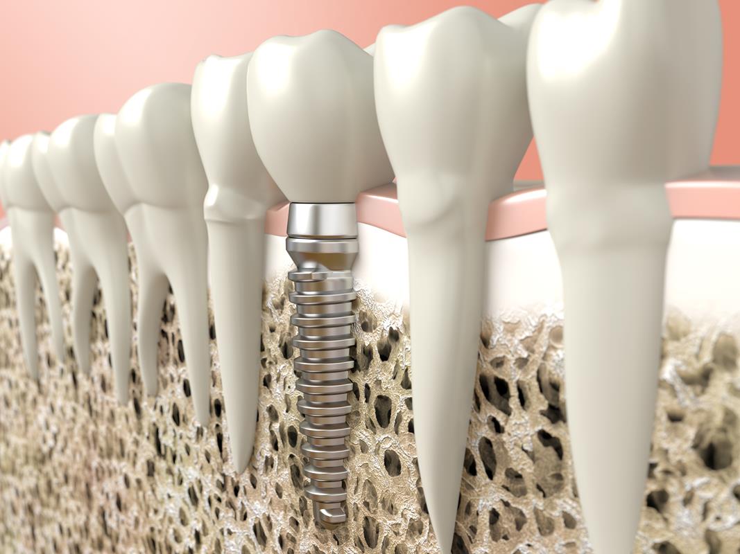 Dental Implants Clinton, NY